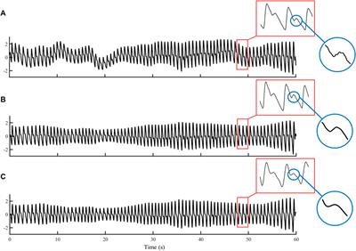 Filtering-induced changes of pulse transmit time across different ages: a neglected concern in photoplethysmography-based cuffless blood pressure measurement